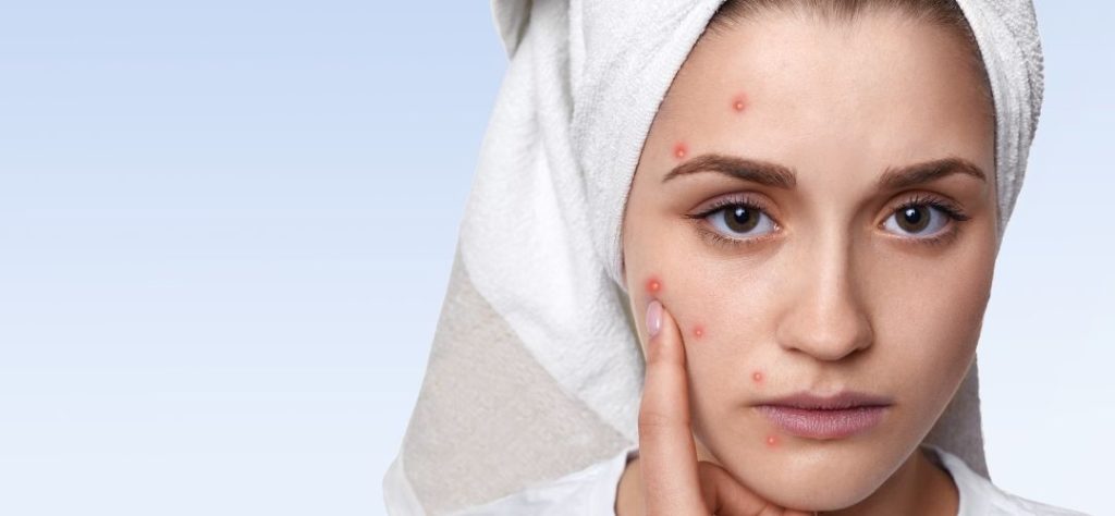 Was tun wenn Pickel sprießen Akne Hautunreinheiten